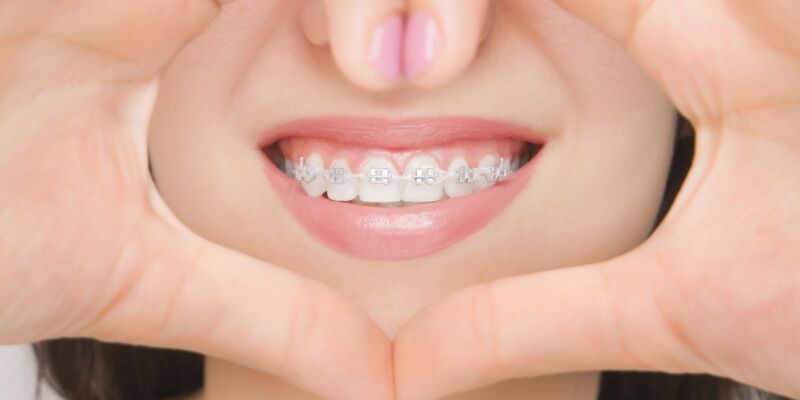 Woman with Damon Braces